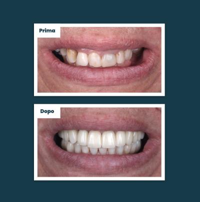 Terapia Implantare Aufiero Caso 01