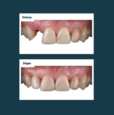 Terapia Implantare Aufiero Caso 05