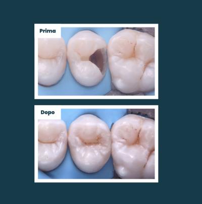 Odontoiatria Conservativa Aufiero Caso 03