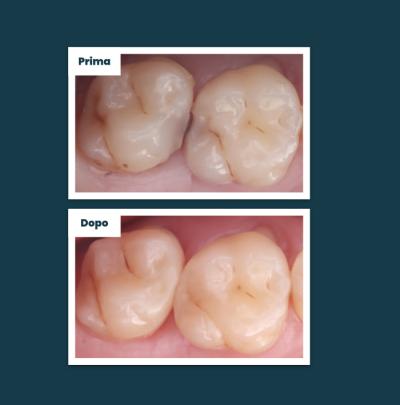 Odontoiatria Conservativa Aufiero Caso 04