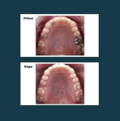 Odontoiatria Conservativa Aufiero Caso 07