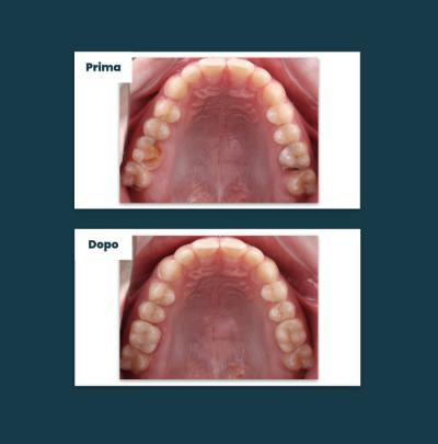 Odontoiatria Conservativa Aufiero Caso 08