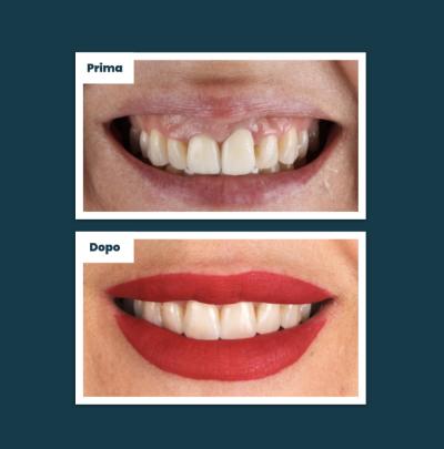 Estetica Sorriso Aufiero Caso 02