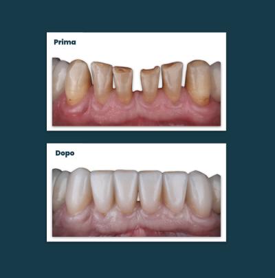 Estetica Sorriso Aufiero Caso 11